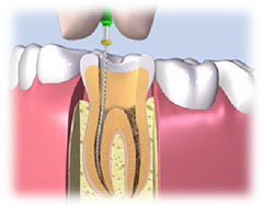 根管治療